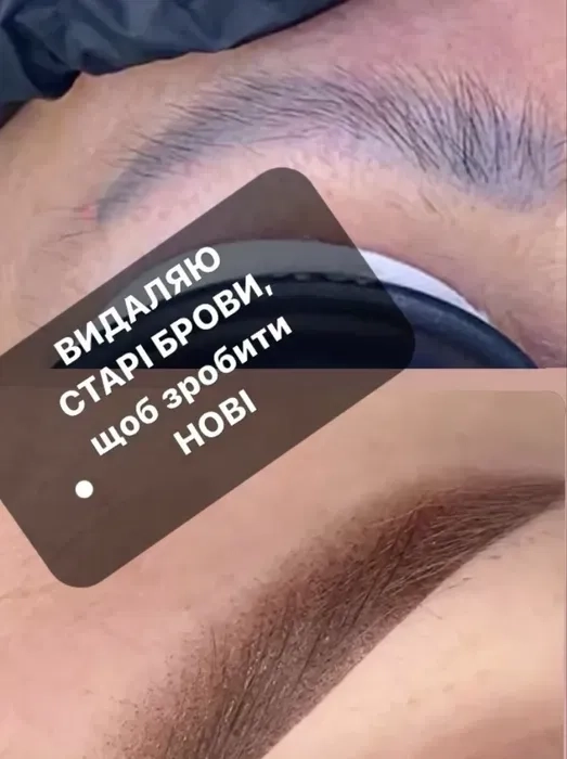 Лазерне видалення татуажу: брови, стрілки та губи.