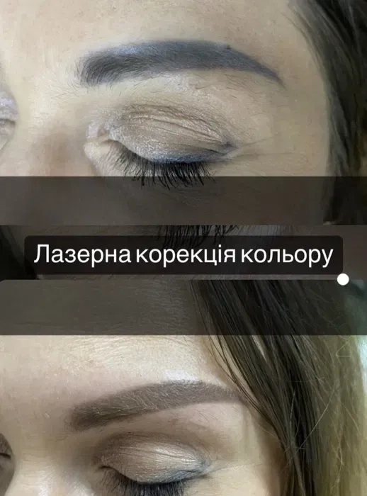 Лазерне видалення татуажу: брови, стрілки та губи.