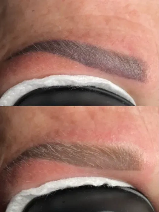 Лазерне видалення татуажу: брови, стрілки та губи.