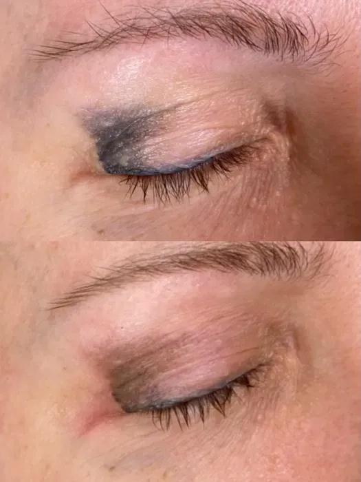 Лазерне видалення татуажу: брови, стрілки та губи.