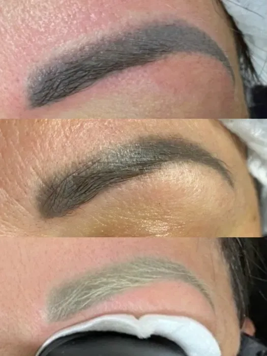 Лазерне видалення татуажу: брови, стрілки та губи.