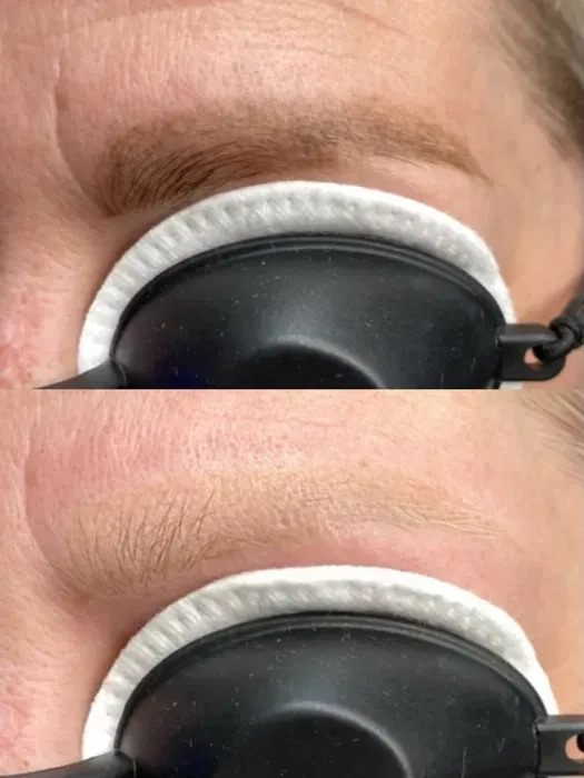 Лазерне видалення татуажу: брови, стрілки та губи.