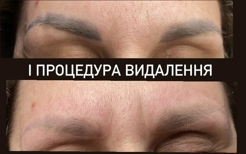 Лазерне видалення татуажу: брови, стрілки та губи.