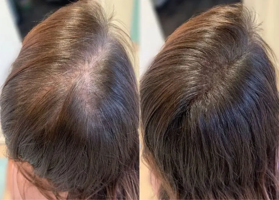 Збільшення губ,ліполітики,розтяжки,випадіння волосся,мікронідлінг