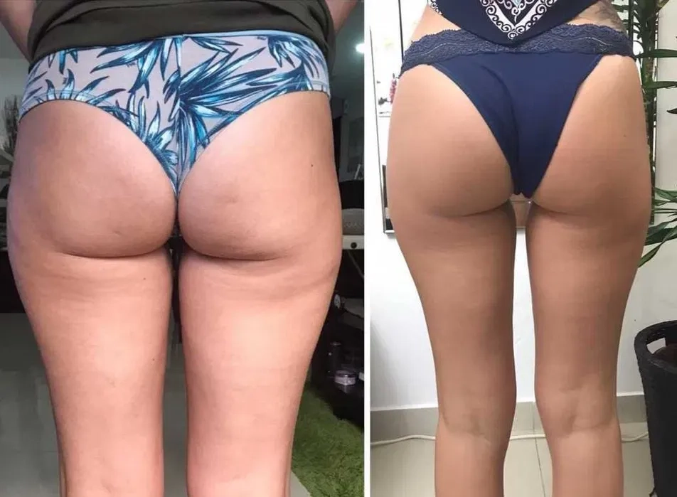 Масаж ніг.Антицелюлітний. (500гр)