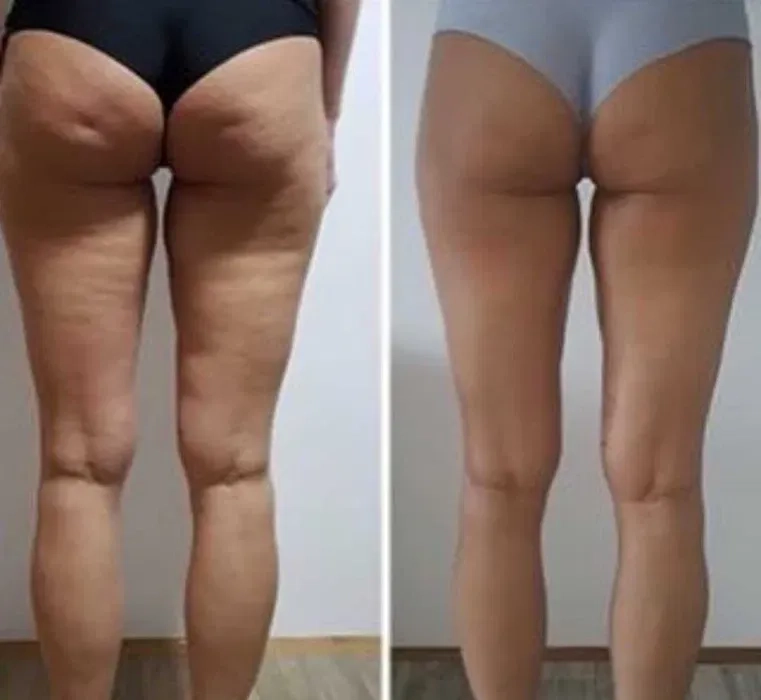 Масаж ніг.Антицелюлітний. (500гр)