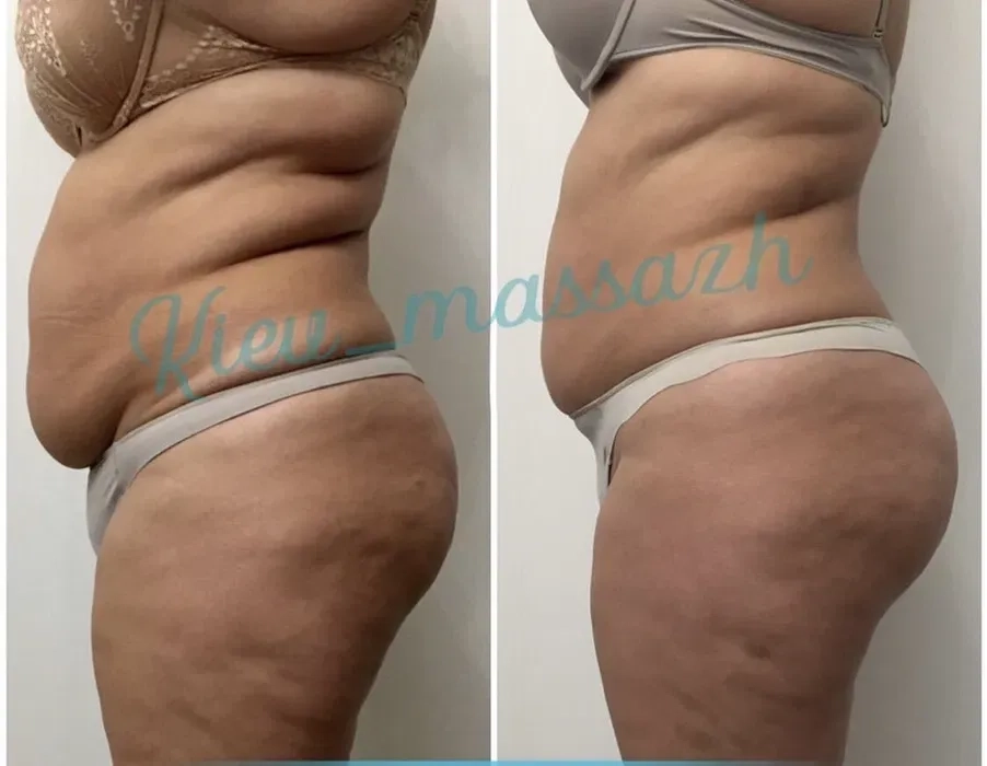 Антицелюлітний масаж (ручний)