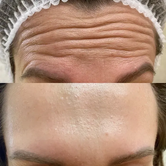 Косметолог (ботокс, контурная пластика губ,мезо, біоревіталізація)