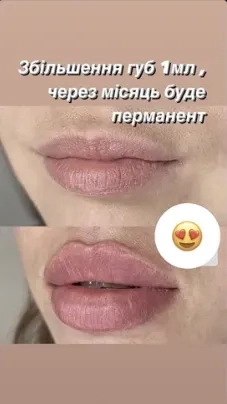 Збільшення губ троєщина 2000