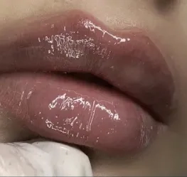 Збільшення губ троєщина 2000