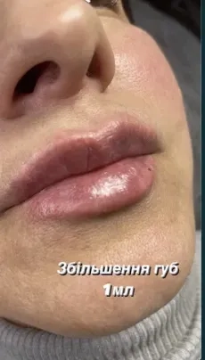 Збільшення губ троєщина 2000