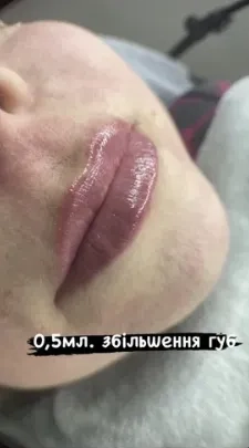 Збільшення губ троєщина 2000