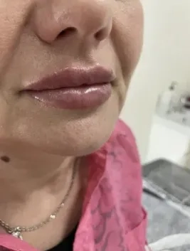 Збільшення губ троєщина 2000