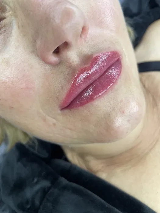 Збільшення губ троєщина 2000