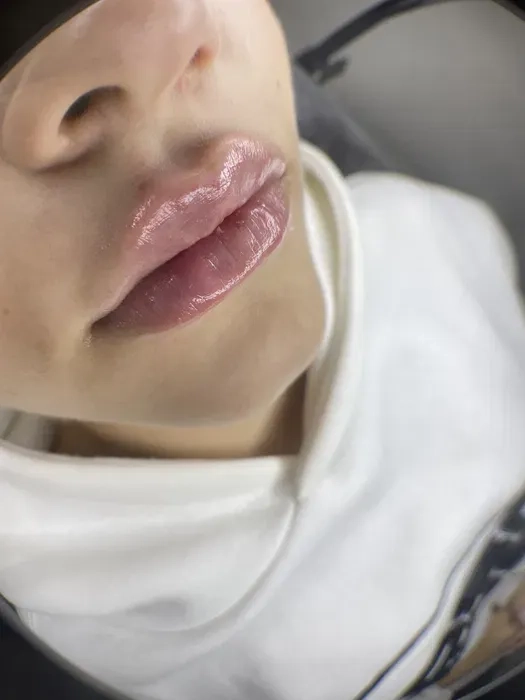 Збільшення губ троєщина 2000