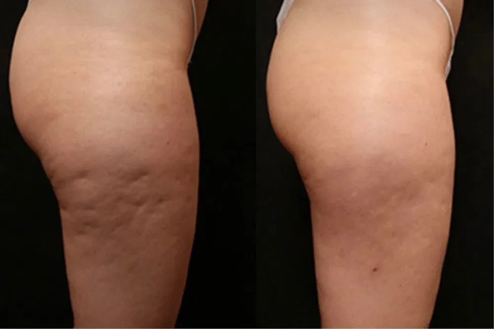 Антицелюлітний апаратний та ручний масаж м осокорки 600грн