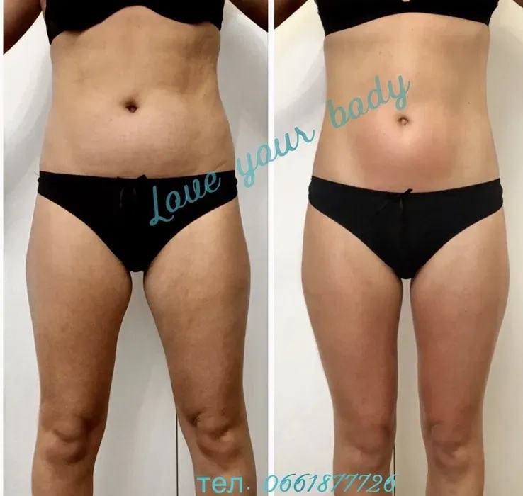 Антицелюлітний масаж ЖК Софія