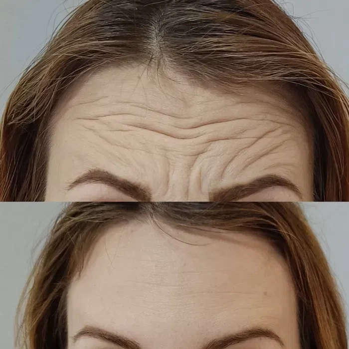 Запрошую на процедуру ботулінотерапії (ботокс). За допомогою цієї процедури можна позбутися мімічних зморшок.