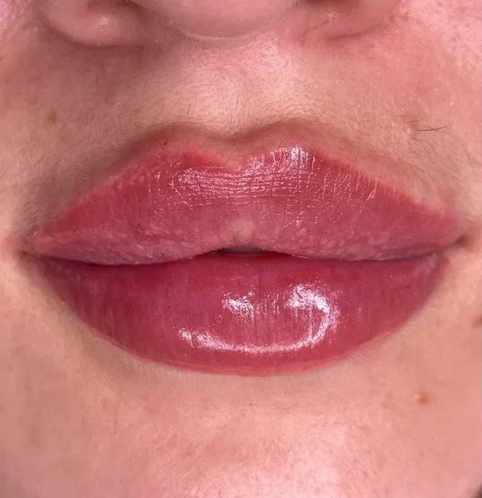 Збільшення губ без болю, без синців! Якісно! Філером гіалуронової кислоти.