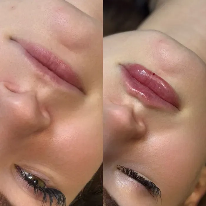 Красиві губи — професійне збільшення