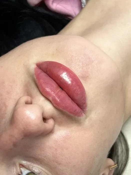 Красиві губи — професійне збільшення