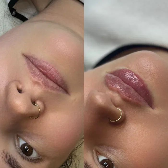 Красиві губи — професійне збільшення