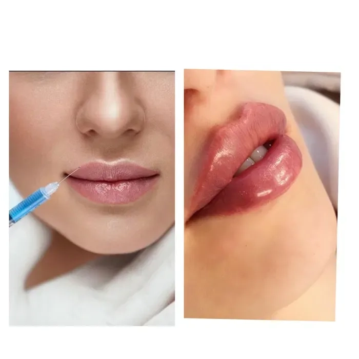 Косметологія, корекція збільшення Губ, Ботокс, Апаратний ліфтинг!