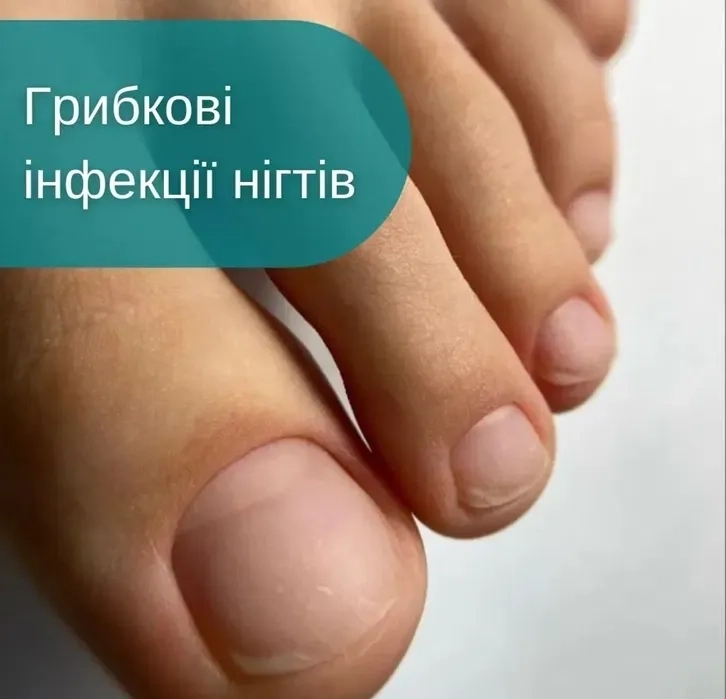 Лікування грибка нігтів — професійно, безпечно, ефективно