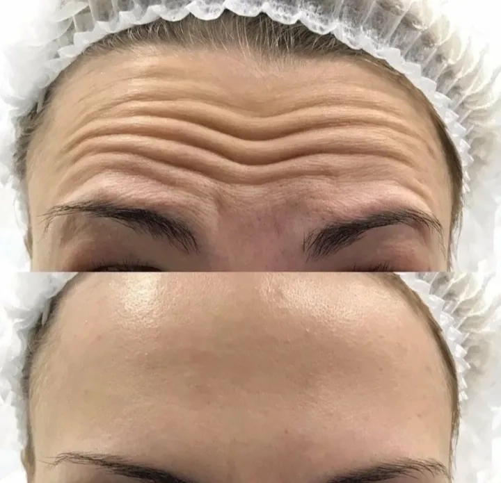 Ботулінотерапія