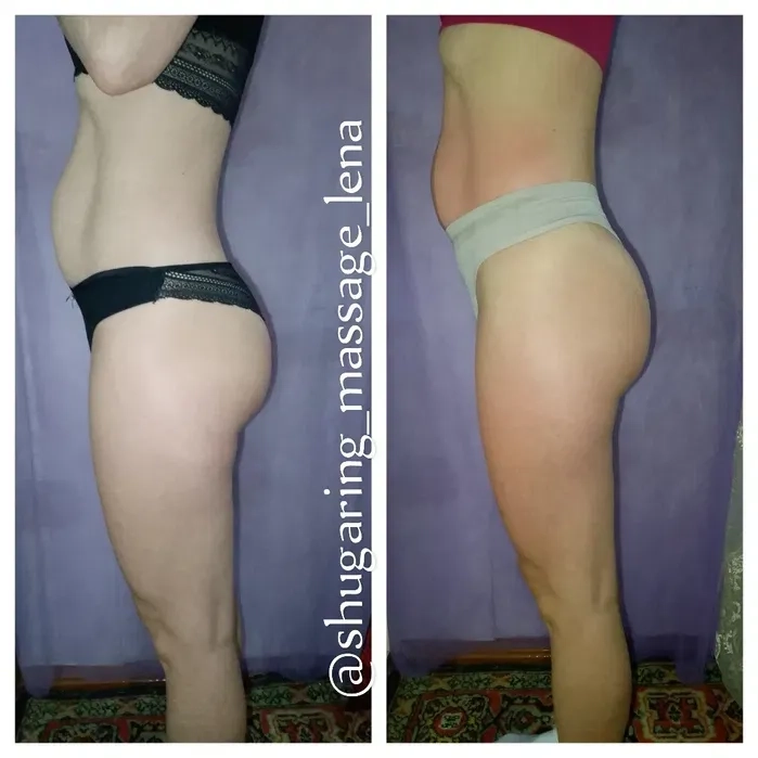 Антицелюлітний масаж – красива фігура швидко