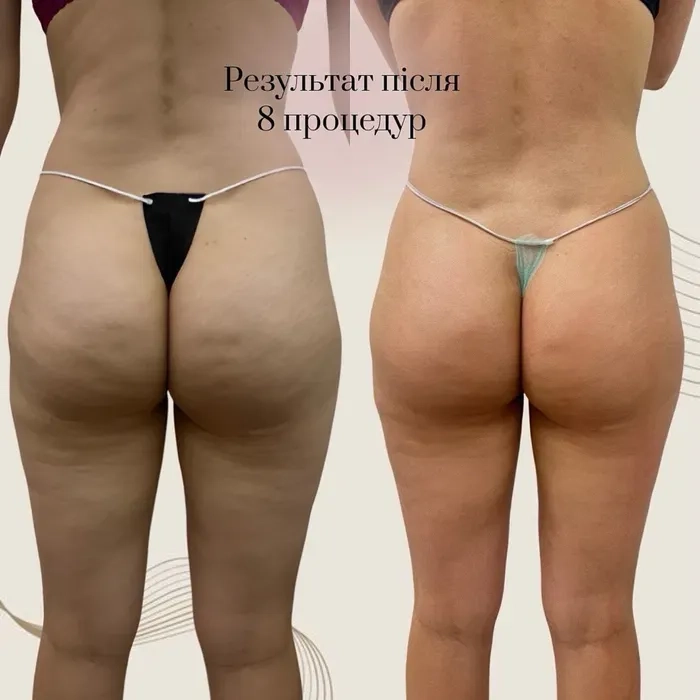 Класичний масаж, Антицелюлітний- моделюючий масаж