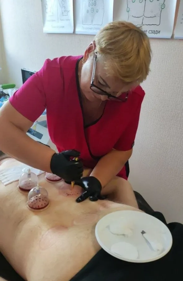 Волога та суха хіджама