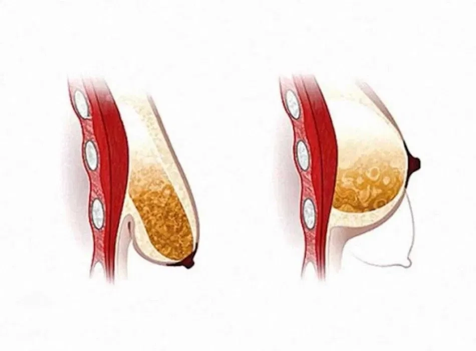 Моделюючий масаж жіночих грудей. Масаж при забоях, ущільненнях.