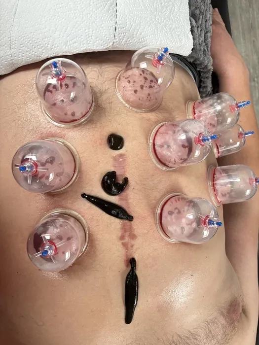 Хіджама. Гірудотерапія. Профілактика всіх захворювань. Навчання.