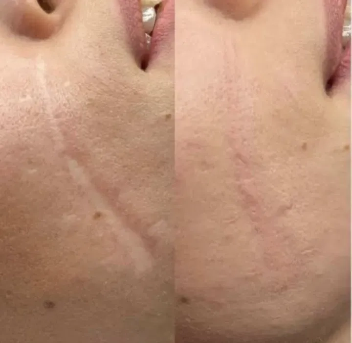 Мікроліндінг-Видалення шрамів-Рубці-Розтяжки 500 грн.