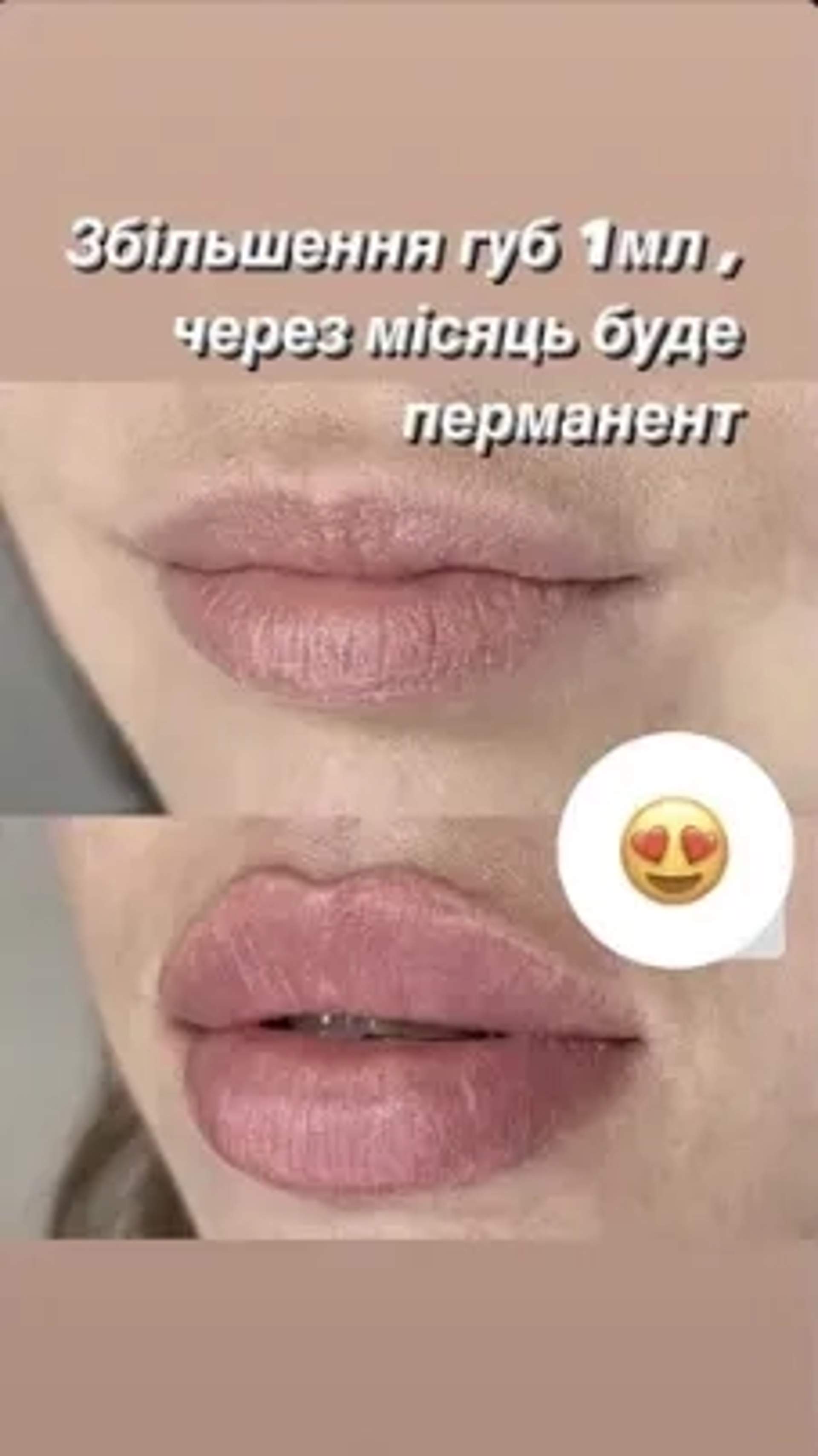 Збільшення губ троєщина 2000
