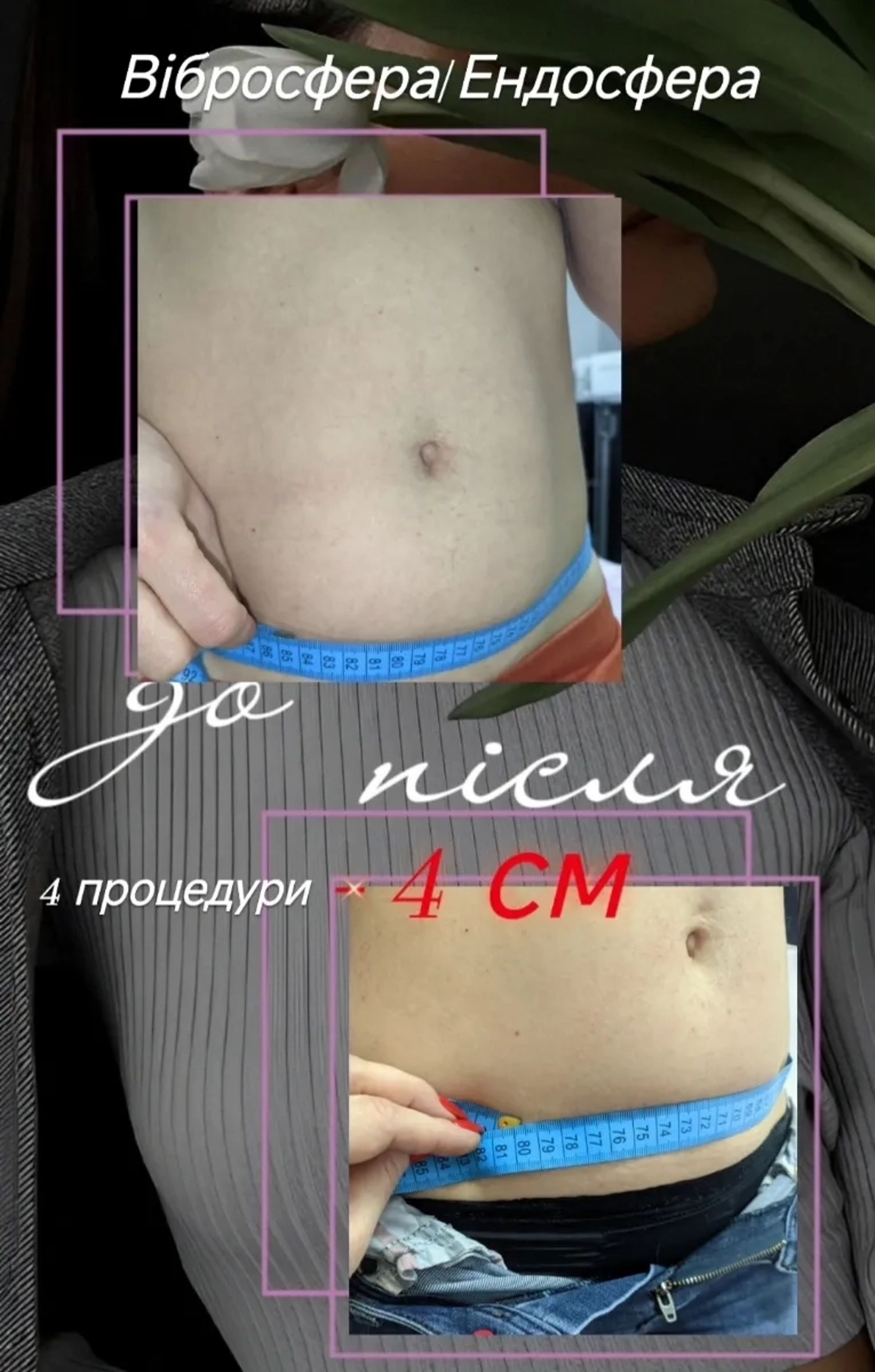 Вібросфера/ Ендосфера апаратний лімфодренажний масаж Записуйтесь!