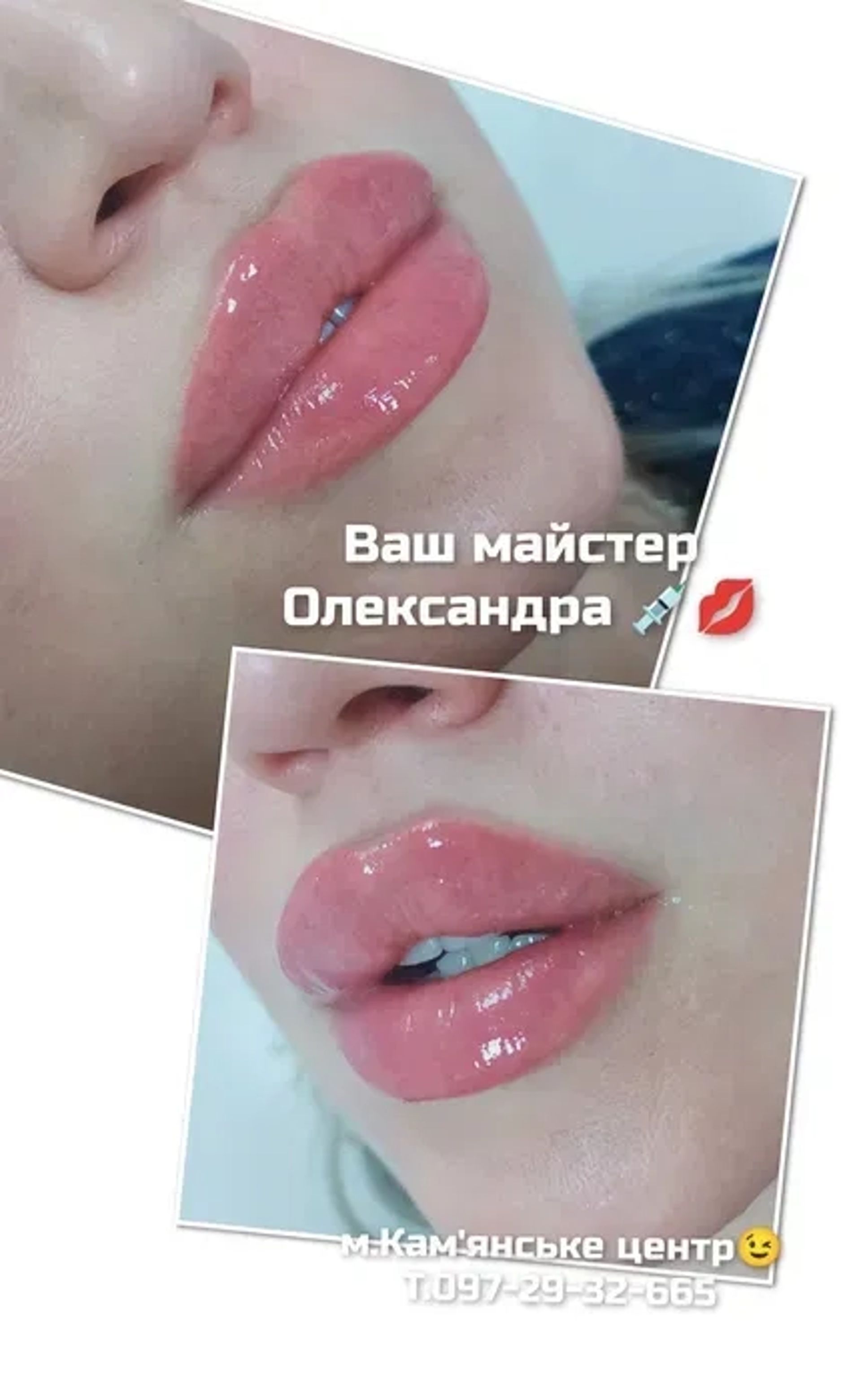 Контурна пластика губ!