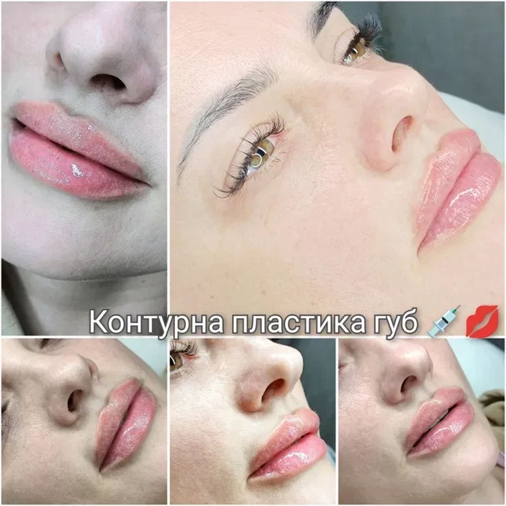 Контурна пластика губ!