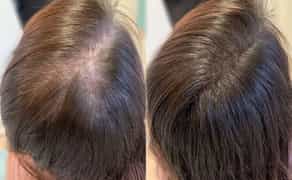 Збільшення губ,ліполітики,розтяжки,випадіння волосся,мікронідлінг