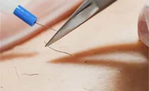 Електроепіляція - Єдиний метод видалення волосся НАЗАВЖДИ