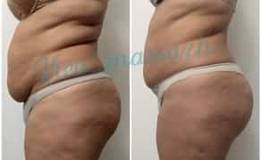 Антицелюлітний масаж (ручний)