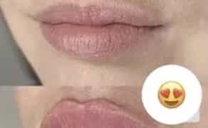 Збільшення губ троєщина 2000