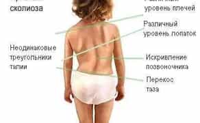 Лікування сколіозу, вальгусу, клишоногості, плоскостопості, порожнистої стопи.