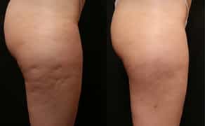 Антицелюлітний апаратний та ручний масаж м осокорки 600грн