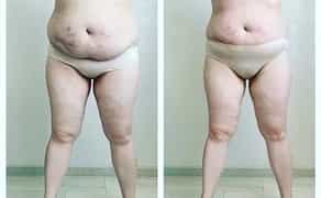 Ендосфера Терапія: Сеанс 60 Хвилин Всього за 400 грн! Ефективна Корекція Фігури!