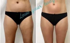 Антицелюлітний масаж ЖК Софія