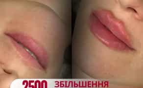 Красиві губи — професійне збільшення