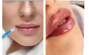 Косметологія, корекція збільшення Губ, Ботокс, Апаратний ліфтинг!