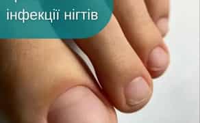 Лікування грибка нігтів — професійно, безпечно, ефективно